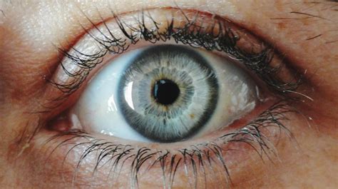 blue limbal ring|blue ring around brown eye.